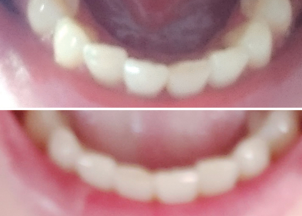 Emaline Lower Teeth