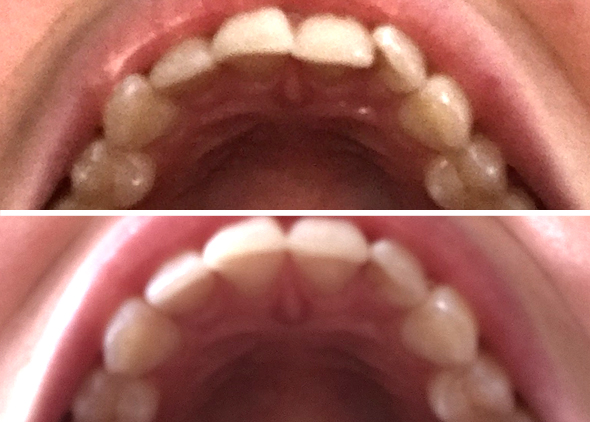 Olivia Upper Teeth