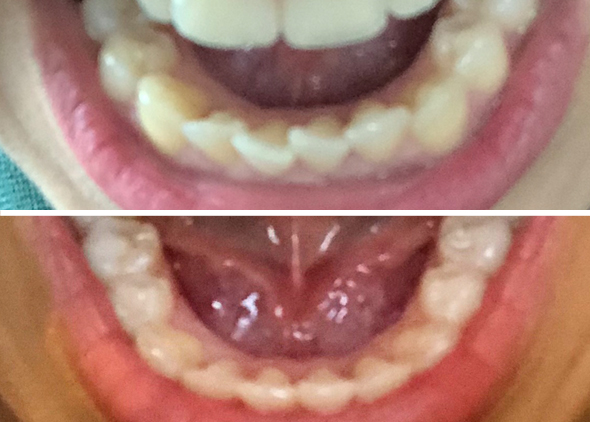Rabina Lower Teeth