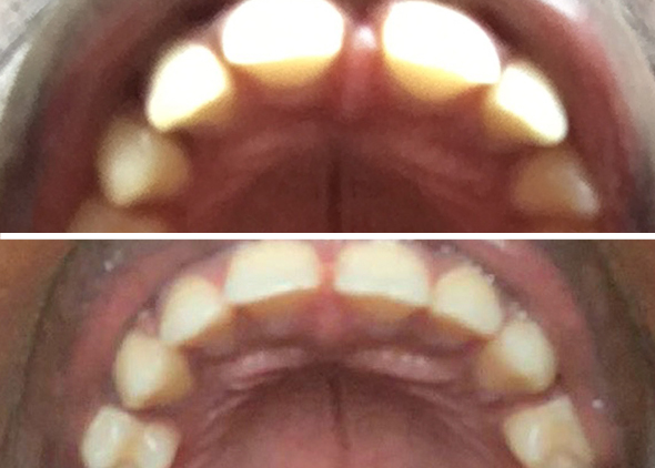 Rimaz Upper Teeth