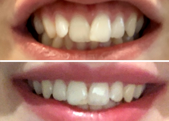 Tiffany Front Teeth