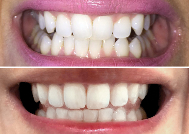 Lisa Front Teeth