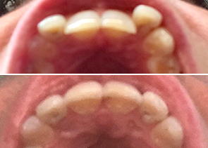 Trina Upper Teeth