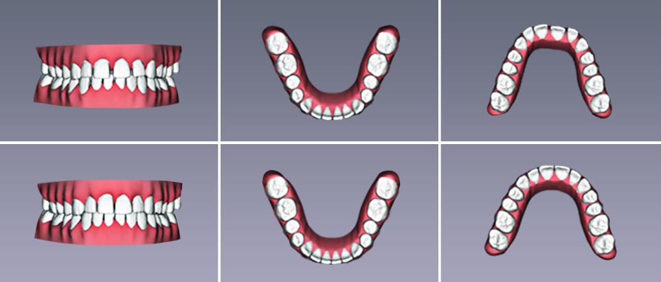 What Happens After You Send back your Impression Kit? 1