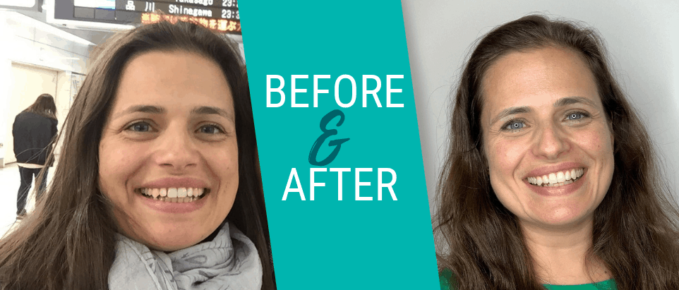 EZ Smile Before & After